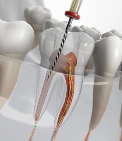 Endodoncia